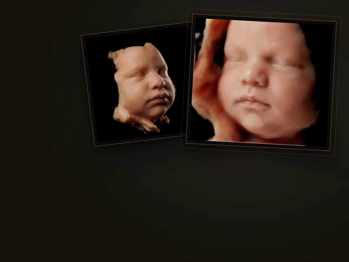 Imagem de ultrassom 3D de um bebê feita na MS Clínica